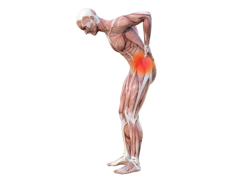 腰に炎症が起こっている人の筋肉の模型